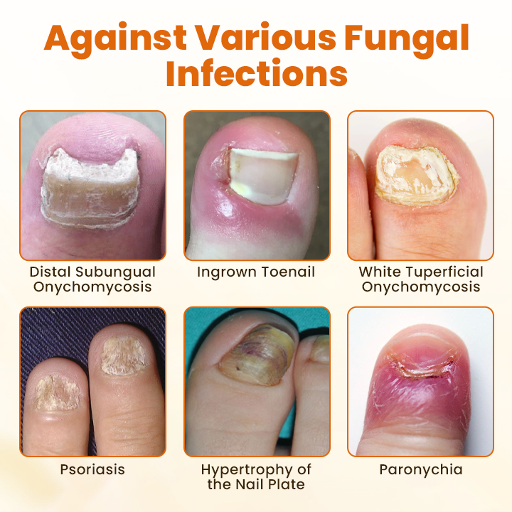 NATRAVOR® FungiBee Advanced Nail Repair Spray