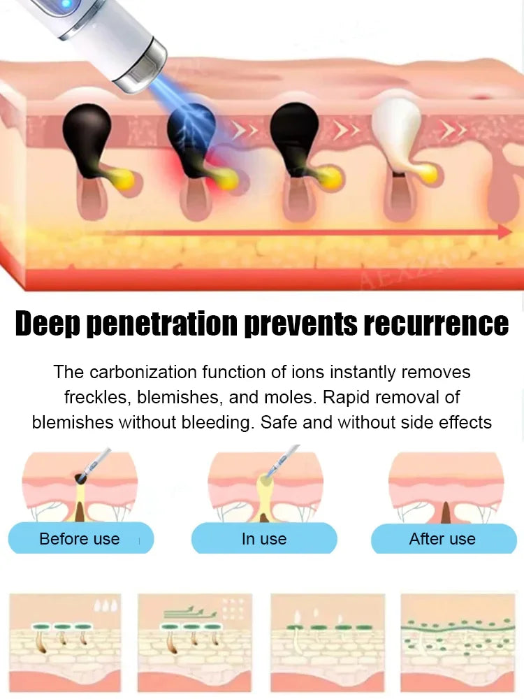 Laser painless wart removal pen--Gentle laser technology for flawless skin—no needles, no scars!