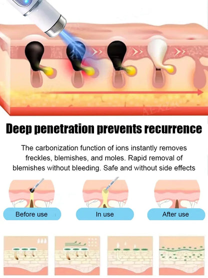 Laser painless wart removal pen--Gentle laser technology for flawless skin—no needles, no scars!