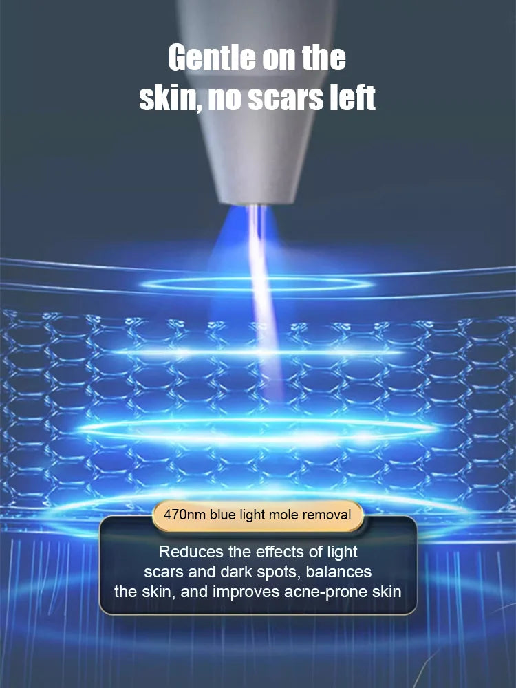 Laser painless wart removal pen--Gentle laser technology for flawless skin—no needles, no scars!