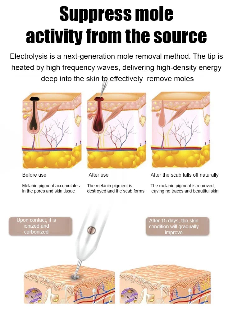 Laser painless wart removal pen--Gentle laser technology for flawless skin—no needles, no scars!