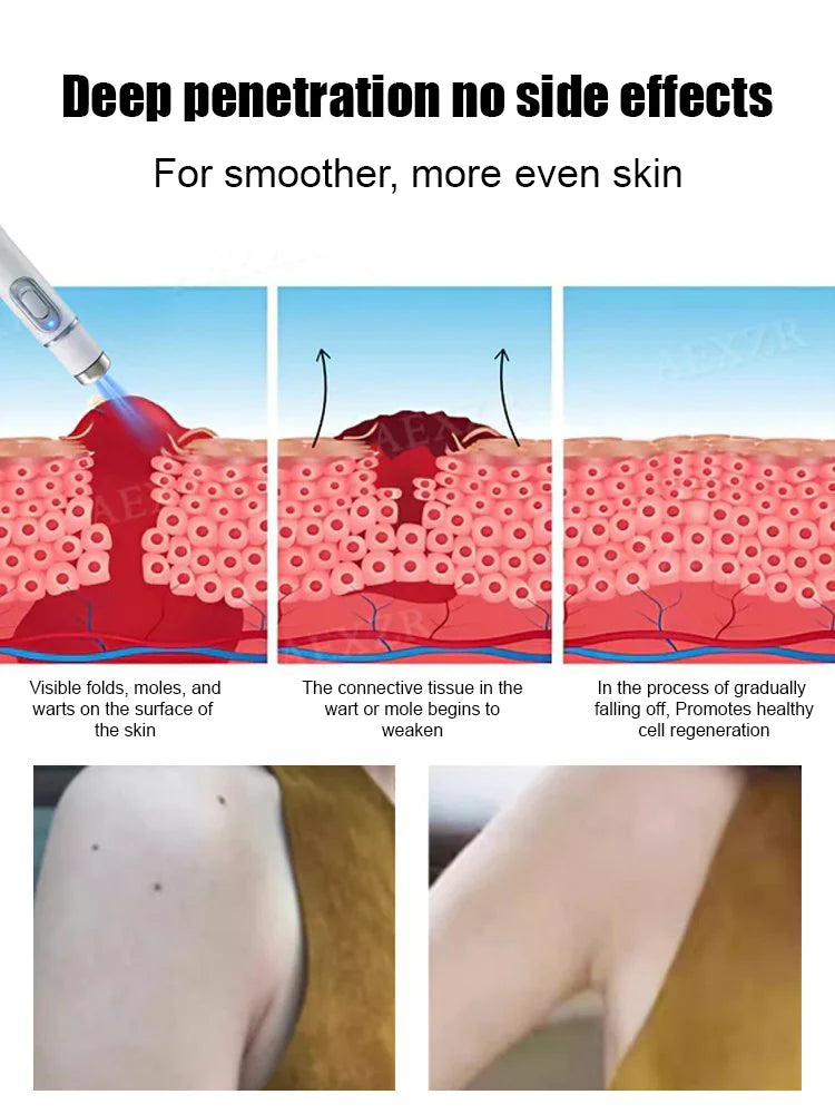Laser painless wart removal pen--Gentle laser technology for flawless skin—no needles, no scars!