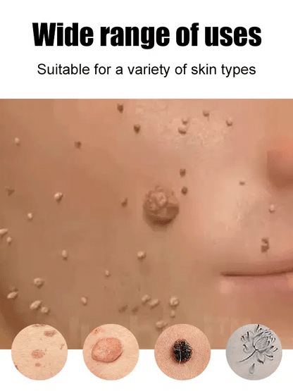 Laser painless wart removal pen--Gentle laser technology for flawless skin—no needles, no scars!