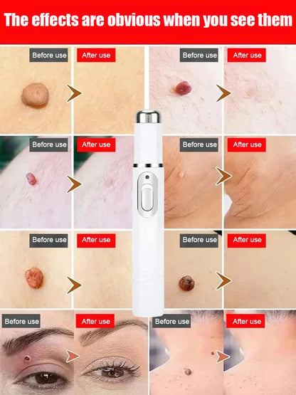 Laser painless wart removal pen--Gentle laser technology for flawless skin—no needles, no scars!